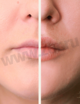 До/после коррекция и увеличение губ